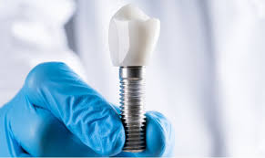 How To Install Dental Implants: Step-By-Step Guide